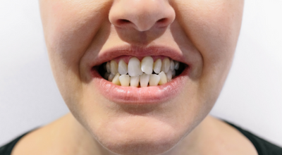 Principais causas da má oclusão dentária
