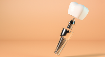 4 tipos de próteses dentárias