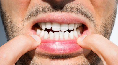 Perigos da má oclusão dental para sua saúde